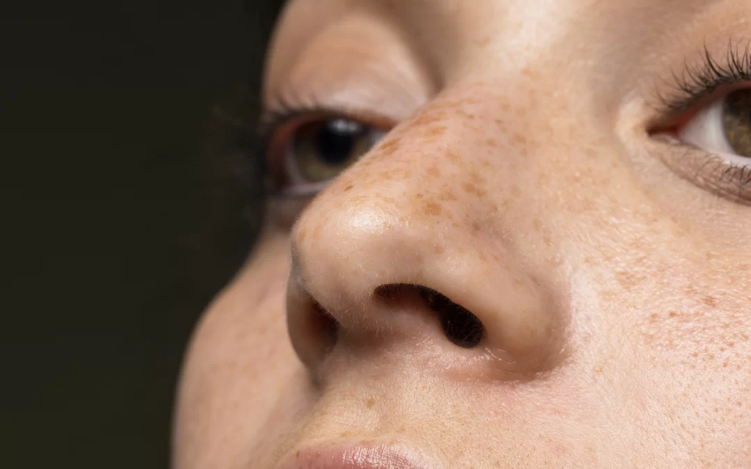 Pecas: causas, cuidados y tratamientos despigmentantes