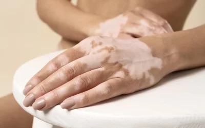 Vitíligo: tipos, causas y tratamientos