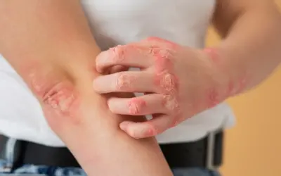 Psoriasis Tratamientos