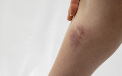 Celulitis y Otras Infecciones Cutáneas: Protege tu Piel