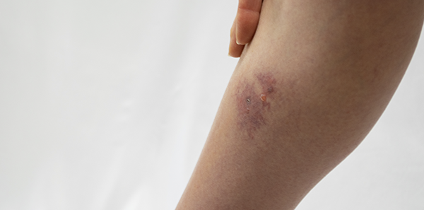 Celulitis y otras infecciones cutáneas