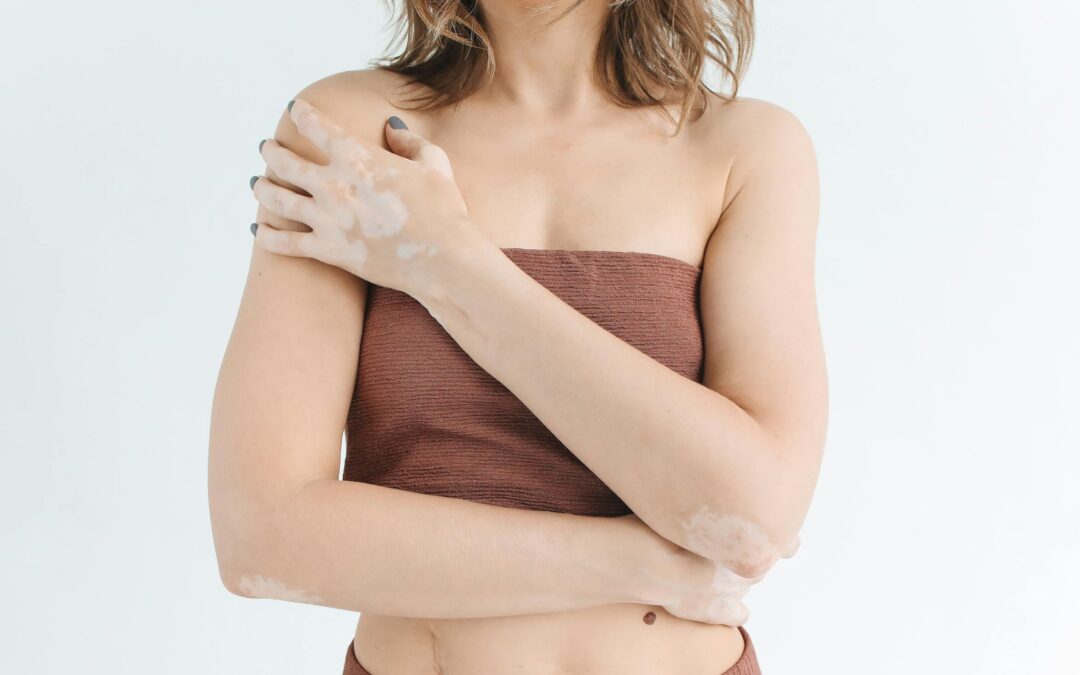 Una condición de piel conocida como vitiligo