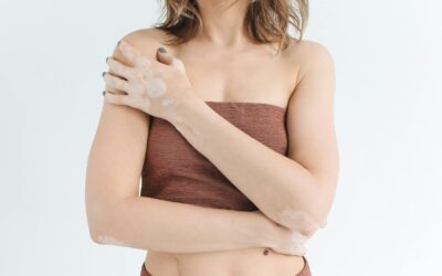 Una condición de piel conocida como vitiligo