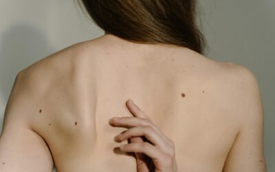 Características del melanoma que debes conocer