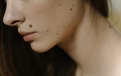 Día Mundial del Melanoma: Conciencia y prevención